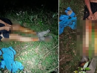 Moradora de Goioer tem pernas amputadas aps acidente com fogueira dentro de casa